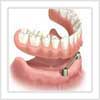 Les Différents types de prothèses dentaires